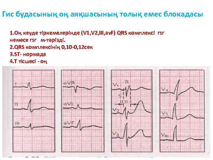 Гис будасының оң аяқшасының толық емес блокадасы 1. Оң кеуде тіркемелерінде (V 1, V