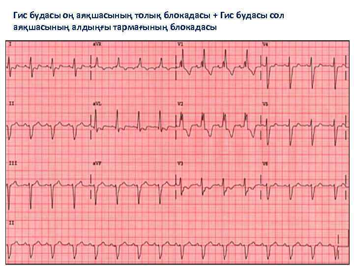 Гис будасы оң аяқшасының толық блокадасы + Гис будасы сол аяқшасының алдыңғы тармағының блокадасы