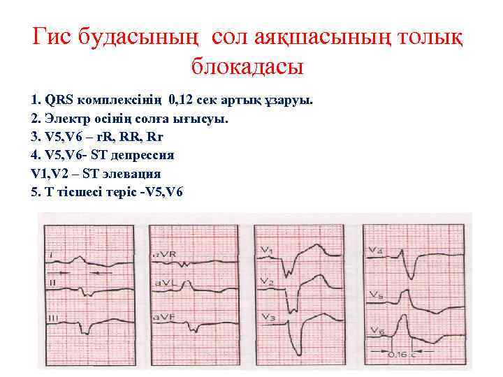 Гис будасының сол аяқшасының толық блокадасы 1. QRS комплексінің 0, 12 сек артық ұзаруы.