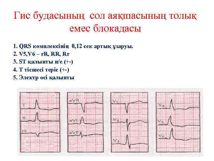 Гис будасының сол аяқшасының толық емес блокадасы 1. QRS комплексінің 0, 12 сек артық