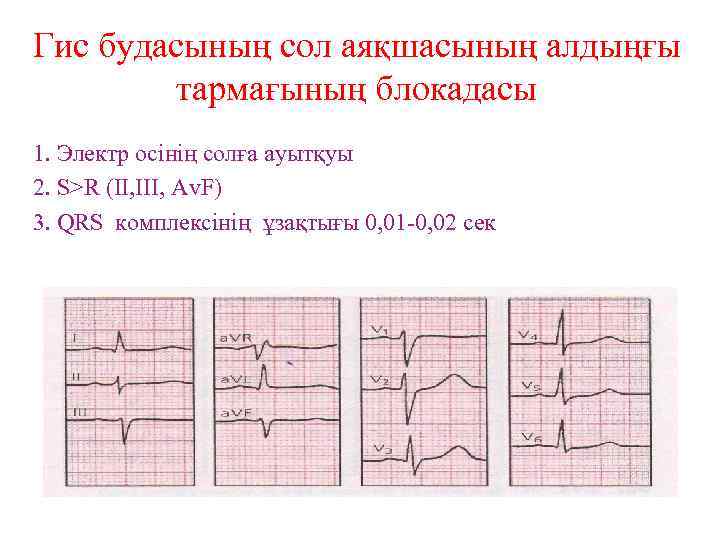 Гис будасының сол аяқшасының алдыңғы тармағының блокадасы 1. Электр осінің солға ауытқуы 2. S>R