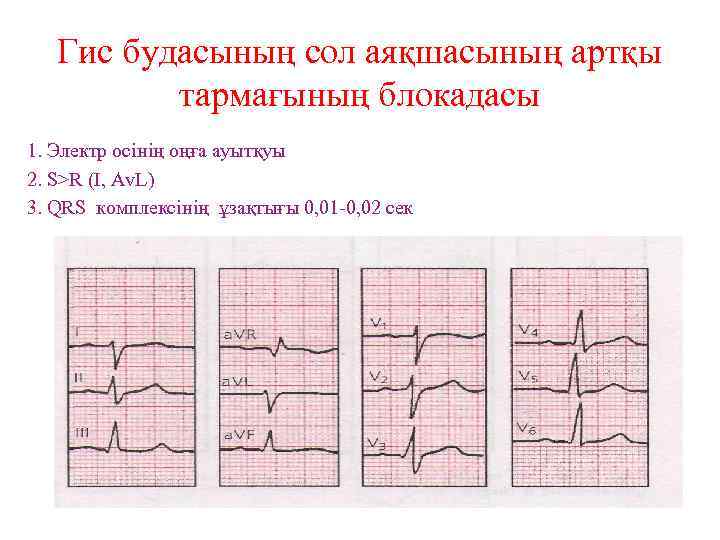 Гис будасының сол аяқшасының артқы тармағының блокадасы 1. Электр осінің оңға ауытқуы 2. S>R