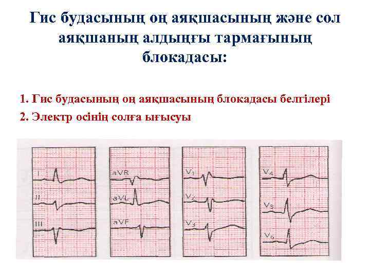 Гис будасының оң аяқшасының және сол аяқшаның алдыңғы тармағының блокадасы: 1. Гис будасының оң