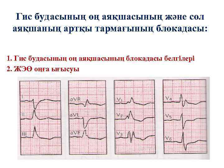 Гис будасының оң аяқшасының және сол аяқшаның артқы тармағының блокадасы: 1. Гис будасының оң