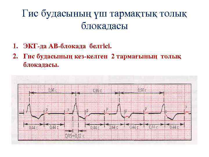 Гис будасының үш тармақтық толық блокадасы 1. ЭКГ-да АВ-блокада белгісі. 2. Гис будасының кез-келген