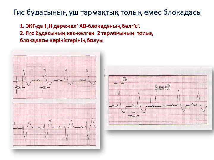 Гис будасының үш тармақтық толық емес блокадасы 1. ЭКГ-да I , II дәрежелі АВ-блокаданың