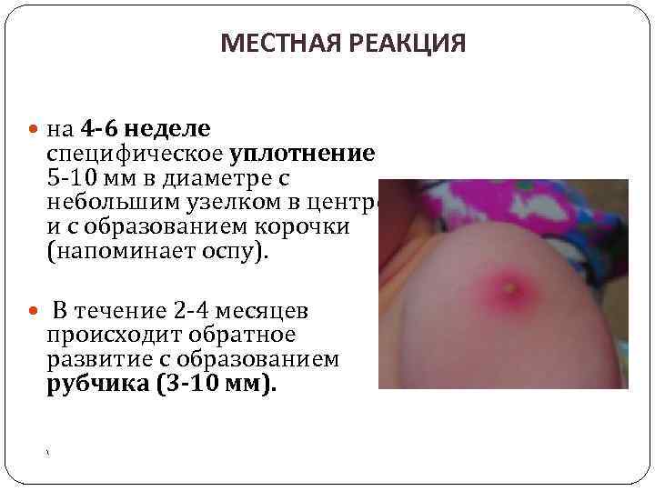 МЕСТНАЯ РЕАКЦИЯ на 4 -6 неделе специфическое уплотнение 5 -10 мм в диаметре с