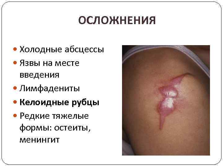 ОСЛОЖНЕНИЯ Холодные абсцессы Язвы на месте введения Лимфадениты Келоидные рубцы Редкие тяжелые формы: остеиты,