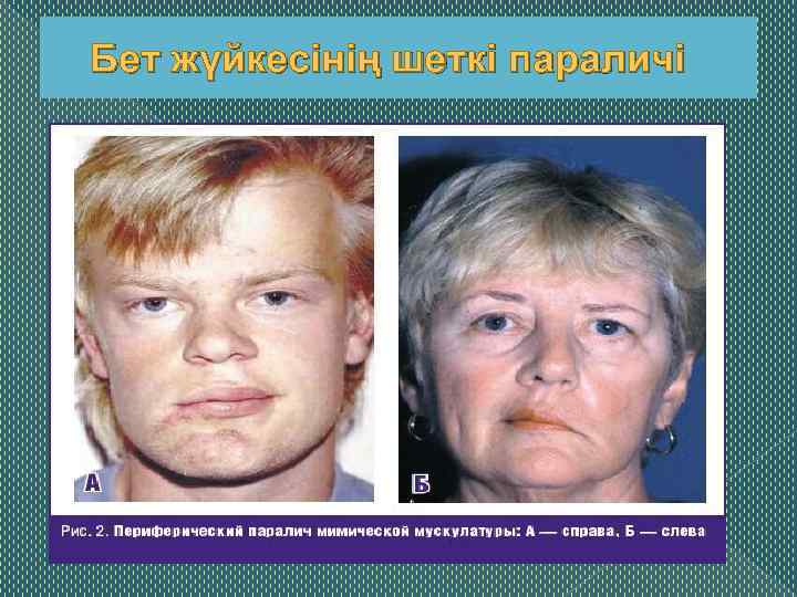 Бет жүйкесінің шеткі параличі 