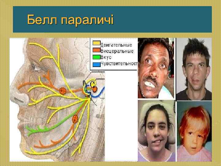 Белл параличі 