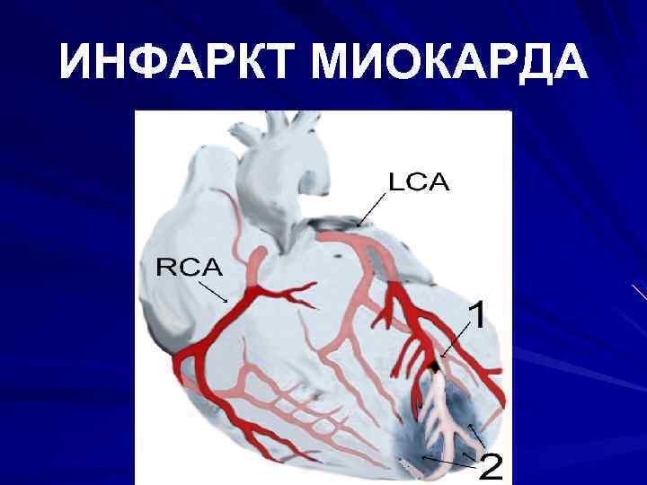 ИНФАРКТ МИОКАРДА 