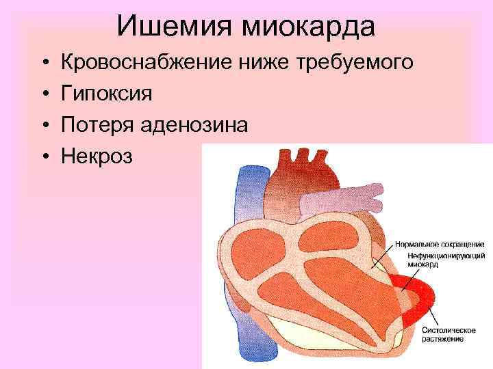 Ишемия миокарда • • Кровоснабжение ниже требуемого Гипоксия Потеря аденозина Некроз 