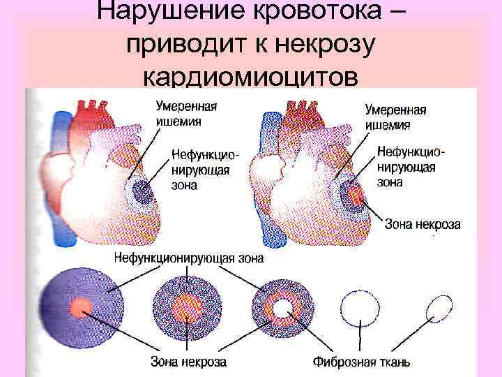 Нарушение кровотока – приводит к некрозу кардиомиоцитов 