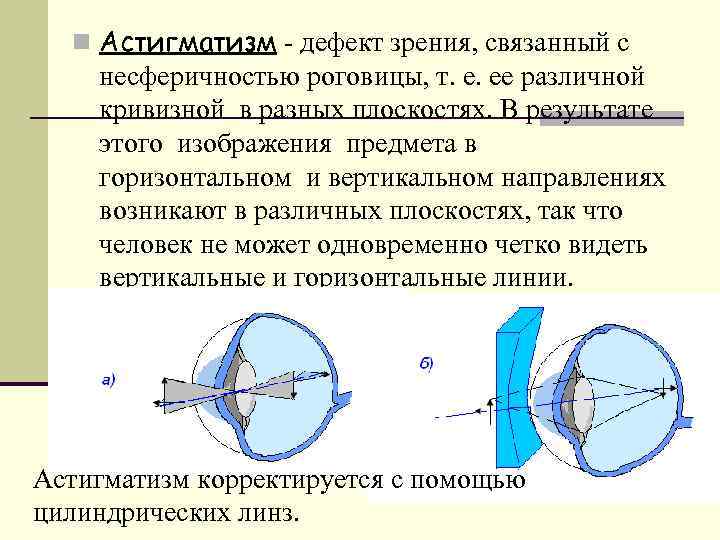 n Астигматизм - дефект зрения, связанный с несферичностью роговицы, т. е. ее различной кривизной