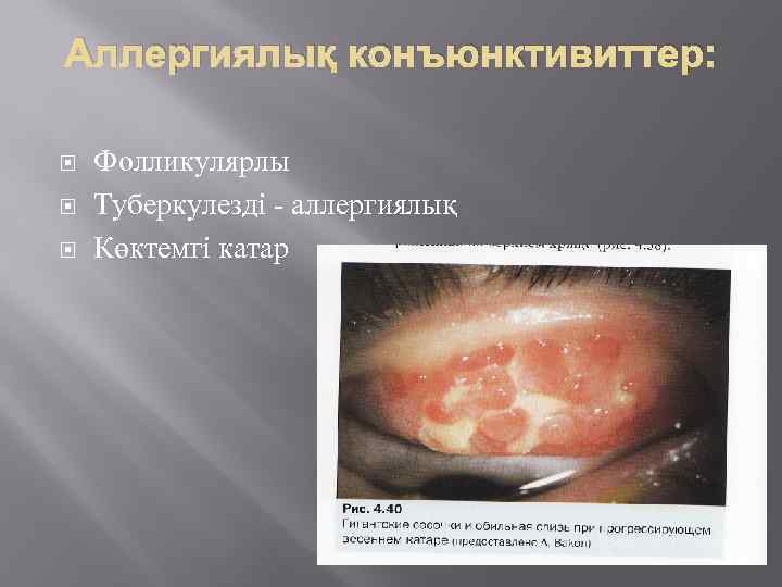 Аллергиялық конъюнктивиттер: Фолликулярлы Туберкулезді - аллергиялық Көктемгі катар 