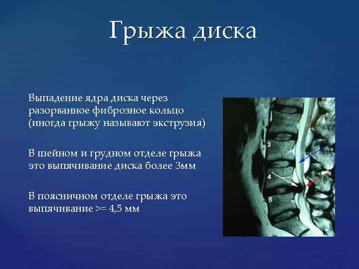 Грыжа диска Выпадение ядра диска через разорванное фиброзное кольцо (иногда грыжу называют экструзия) В