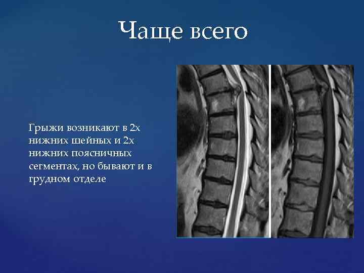 Чаще всего Грыжи возникают в 2 х нижних шейных и 2 х нижних поясничных