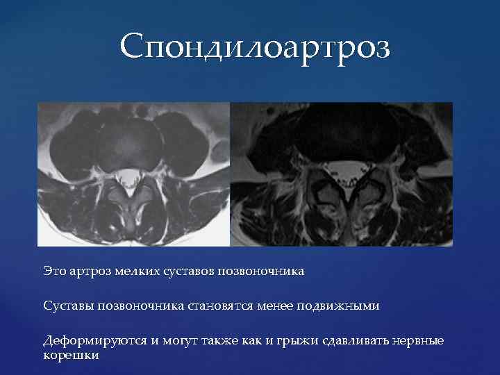 Спондилоартроз Это артроз мелких суставов позвоночника Суставы позвоночника становятся менее подвижными Деформируются и могут
