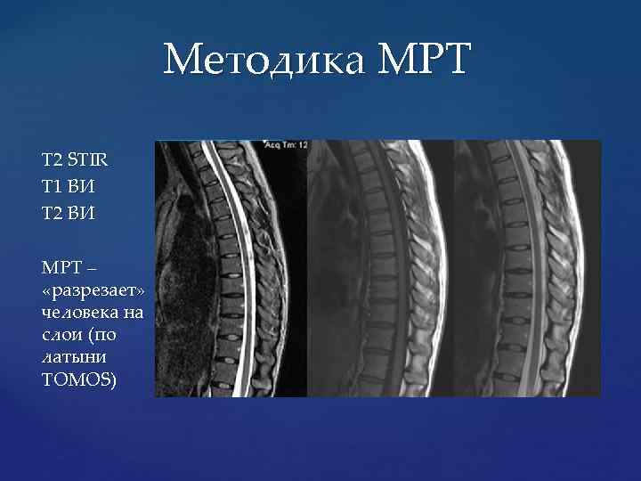 Методика МРТ Т 2 STIR Т 1 ВИ Т 2 ВИ МРТ – «разрезает»