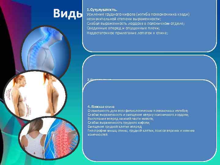 Виды нарушений: 1. Сутулуватость. Усиление грудного кифоза (изгиба позвоночника кзади) незначительной степени выраженности; Слабая
