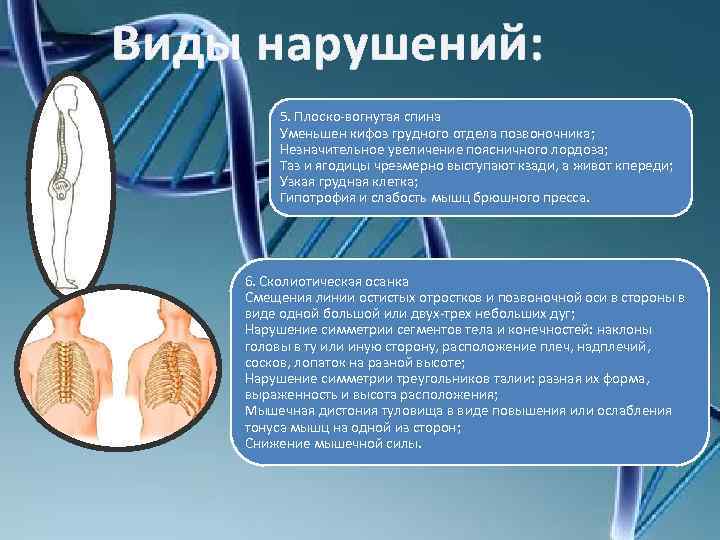 Виды нарушений: 5. Плоско-вогнутая спина Уменьшен кифоз грудного отдела позвоночника; Незначительное увеличение поясничного лордоза;