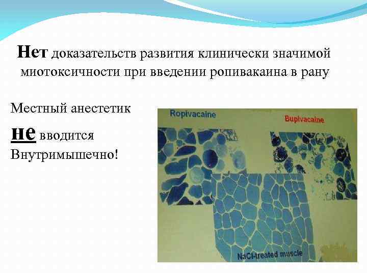 Нет доказательств развития клинически значимой миотоксичности при введении ропивакаина в рану Местный анестетик не