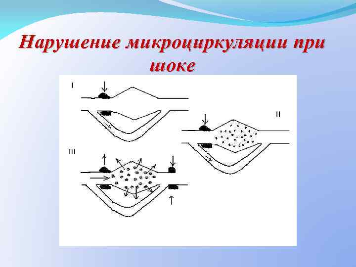 Нарушение микроциркуляции при шоке 