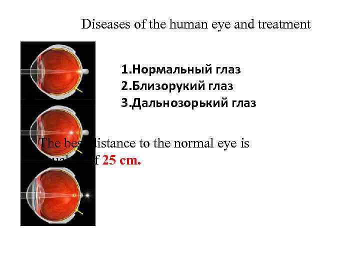 Diseases of the human eye and treatment 1. Нормальный глаз 2. Близорукий глаз 3.