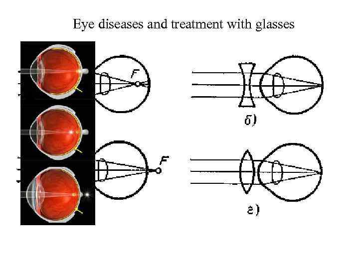 Eye diseases and treatment with glasses 