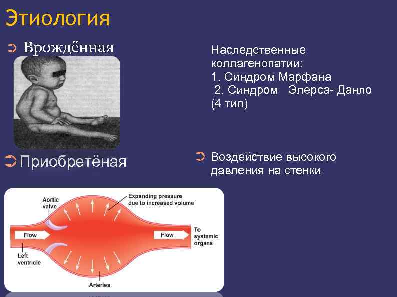 Коллагенопатия. Наследственные коллагенопатии. Наследственные коллагенопатии патогенез. Синдром Марфана этиология патогенез.