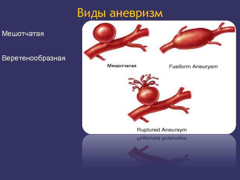 Мешотчатая аневризма. Мешотчатая аневризма сосудов. Фузиформная аневризма. Фузиформная и мешотчатая аневризма. Мешковидная аневризма.