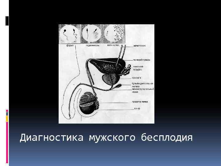Диагностика мужского бесплодия 