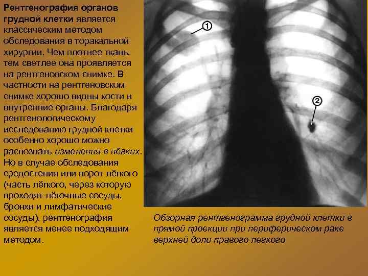 Рентгенография органов грудной клетки является классическим методом обследования в торакальной хирургии. Чем плотнее ткань,