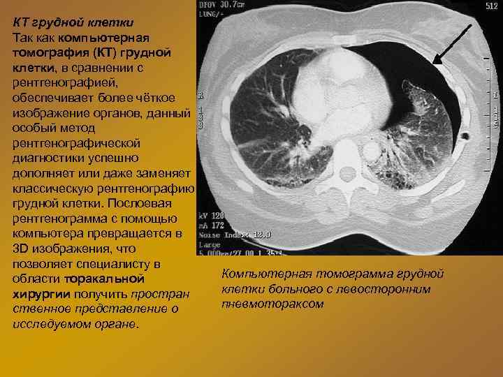 КТ грудной клетки Так компьютерная томография (КТ) грудной клетки, в сравнении с рентгенографией, обеспечивает