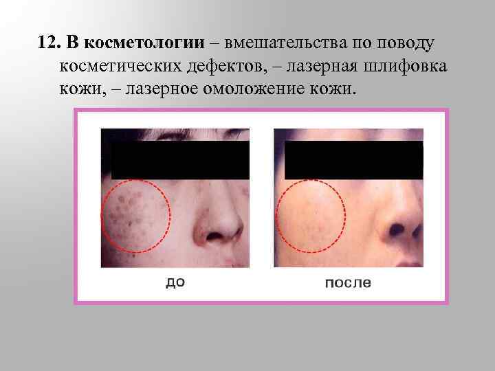 12. В косметологии – вмешательства по поводу косметических дефектов, – лазерная шлифовка кожи, –