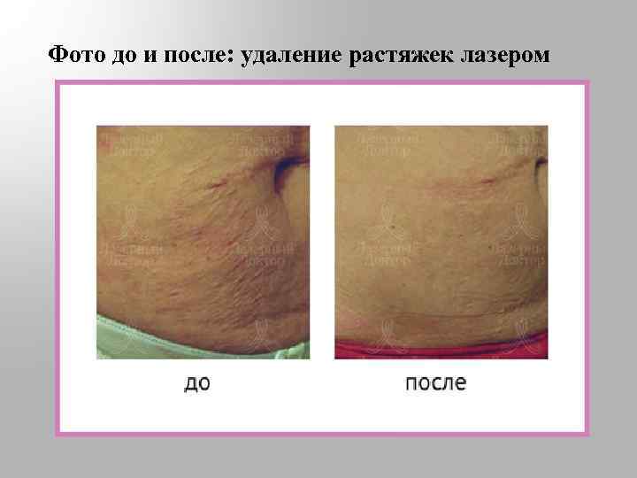 Фото до и после: удаление растяжек лазером 