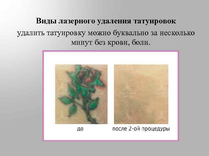 Виды лазерного удаления татуировок удалить татуировку можно буквально за несколько минут без крови, боли.