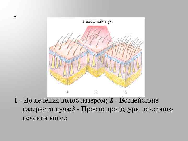 - 1 - До лечения волос лазером; 2 - Воздействие лазерного луча; 3 -