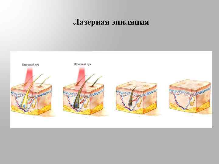 Лазерная эпиляция 
