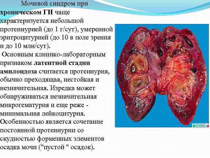 Мочевой синдром при хроническом ГН чаще характеризуется небольшой протеинурией (до 1 г/сут), умеренной эритроцитурией