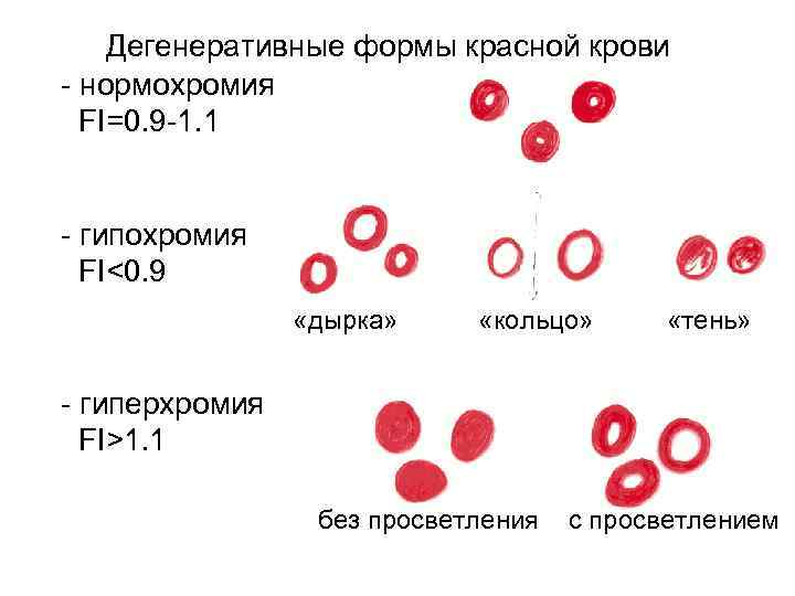 Дегенеративные формы красной крови - нормохромия FI=0. 9 -1. 1 - гипохромия FI<0. 9