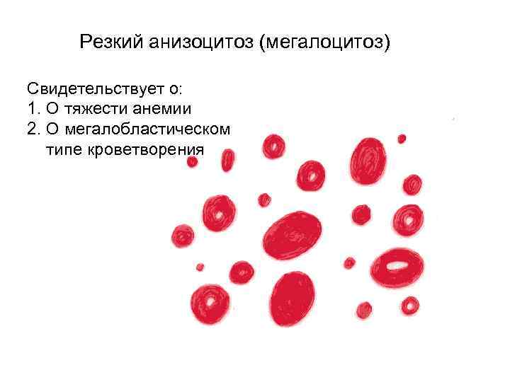 Резкий анизоцитоз (мегалоцитоз) Свидетельствует о: 1. О тяжести анемии 2. О мегалобластическом типе кроветворения