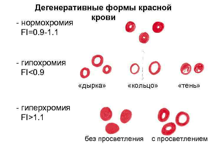 Дегенеративные формы красной крови - нормохромия FI=0. 9 -1. 1 - гипохромия FI<0. 9