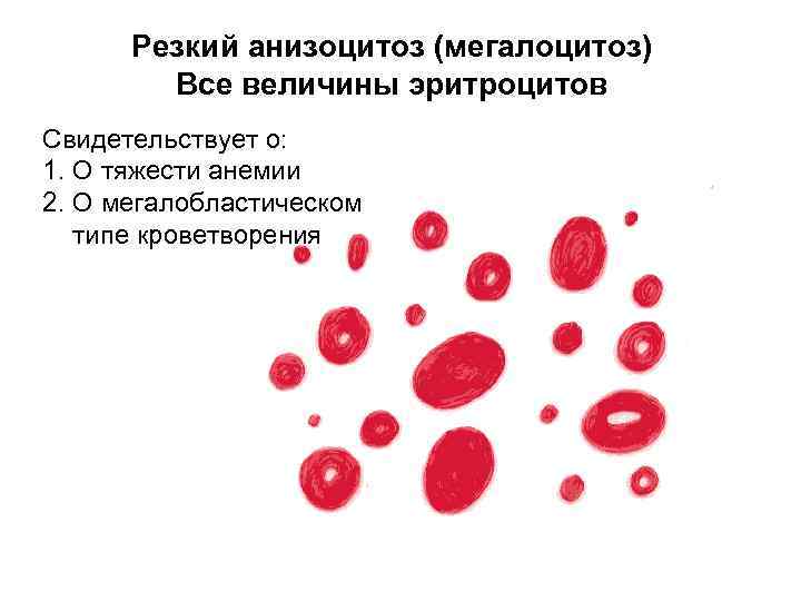 Пойкилоцитоз анемия. Анизоцитоз и пойкилоцитоз. Анизоцитоз микроцитоз. Анизоцитоз анемия. Величина эритроцитов.