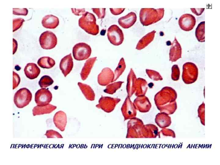 Анемия типовой патологический процесс