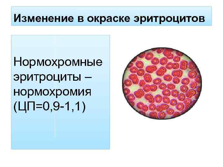 Изменение в окраске эритроцитов Нормохромные эритроциты – нормохромия (ЦП=0, 9 -1, 1) 