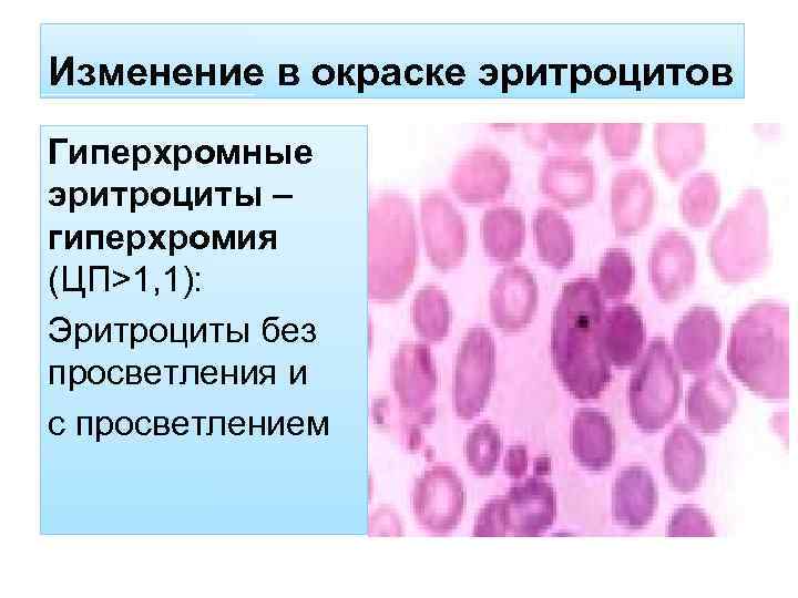 Изменение в окраске эритроцитов Гиперхромные эритроциты – гиперхромия (ЦП˃1, 1): Эритроциты без просветления и
