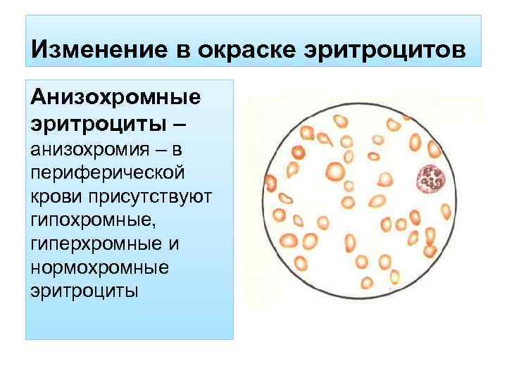 Изменение в окраске эритроцитов Анизохромные эритроциты – анизохромия – в периферической крови присутствуют гипохромные,