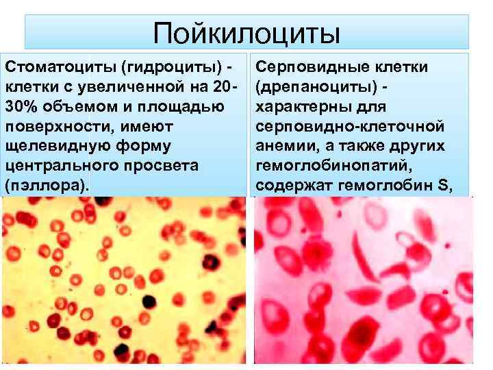 Пойкилоциты Стоматоциты (гидроциты) клетки с увеличенной на 2030% объемом и площадью поверхности, имеют щелевидную