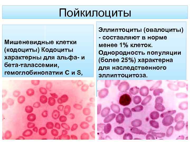 Пойкилоциты Мишеневидные клетки (кодоциты) Кодоциты характерны для альфа- и бета-талассемии, гемоглобинопатии С и S,